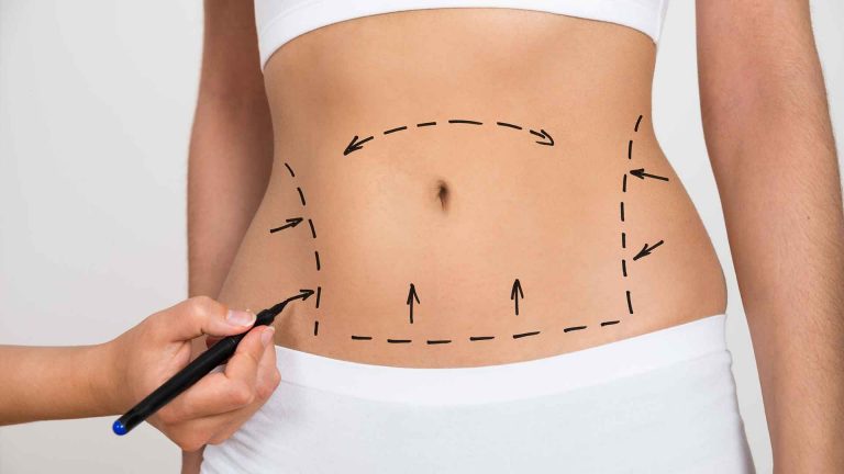 A woman with lines on her stomach in preparation for a mommy makeover.