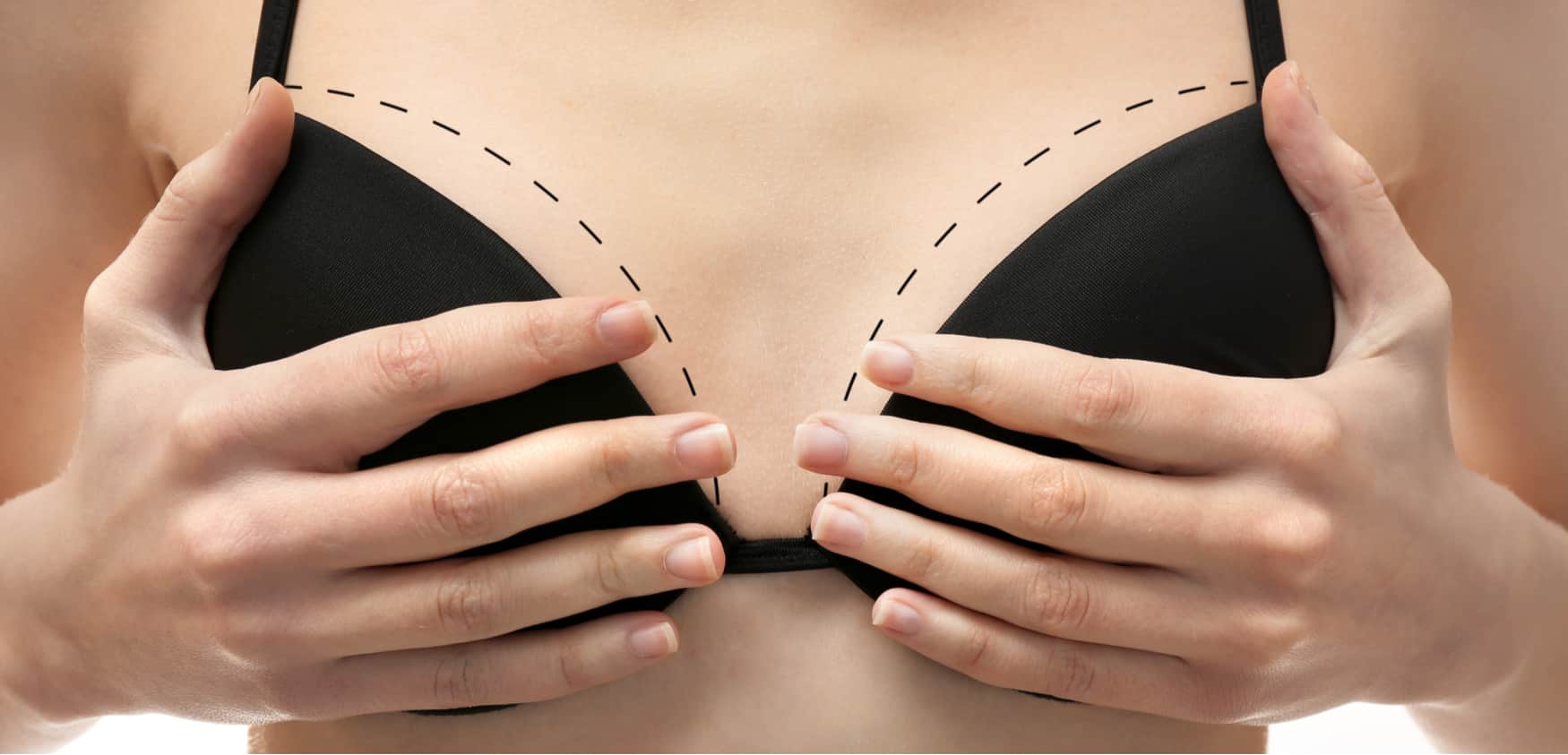 A woman with dotted lines on her breasts to represent breast lift surgery