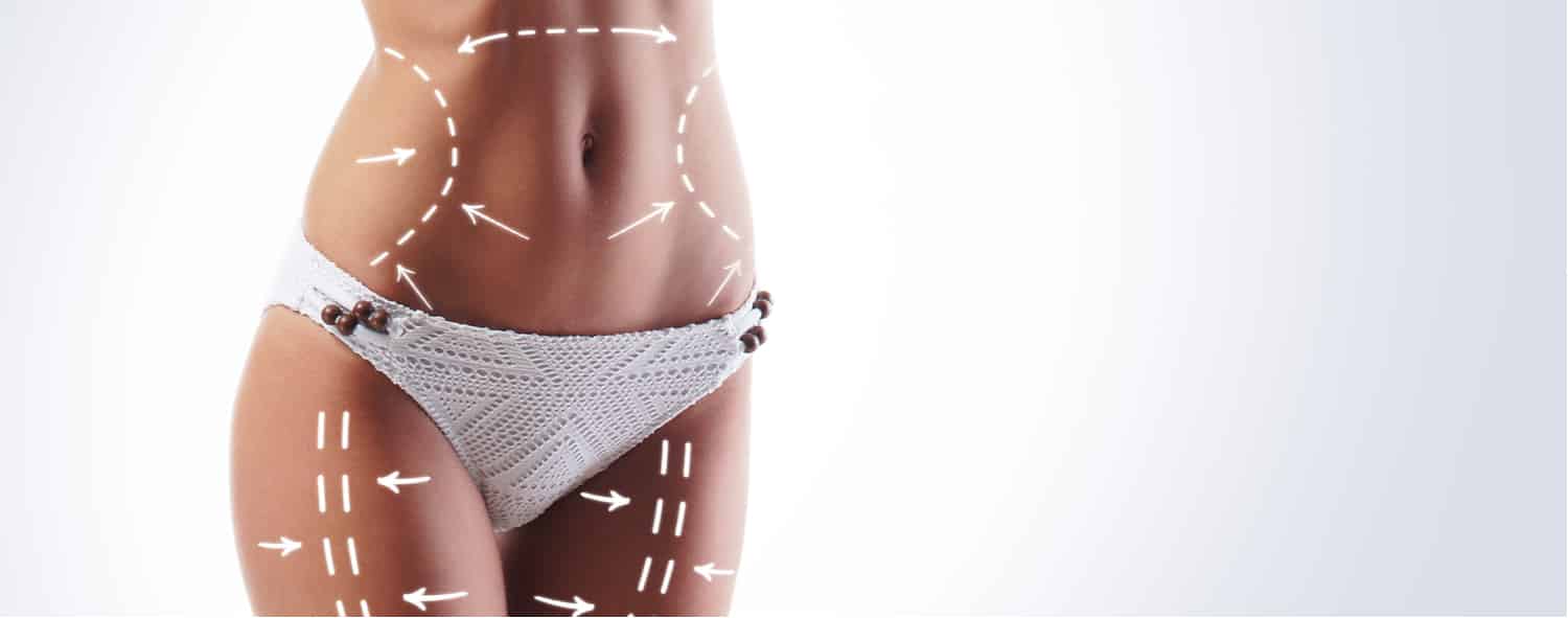 A woman with lines drawn on her abdomen to show a mini tummy tuck combined with other plastic surgeries