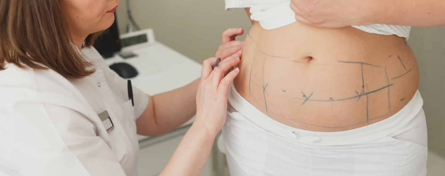A surgeon marking a woman's stomach in preparation for fat removal with liposuction