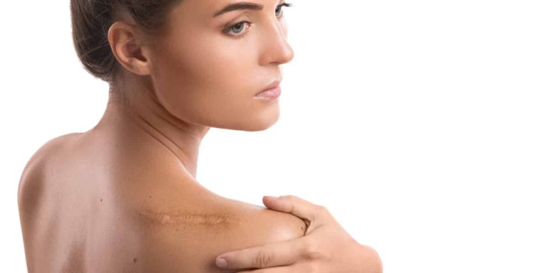 A woman who may benefit from scar revision surgery