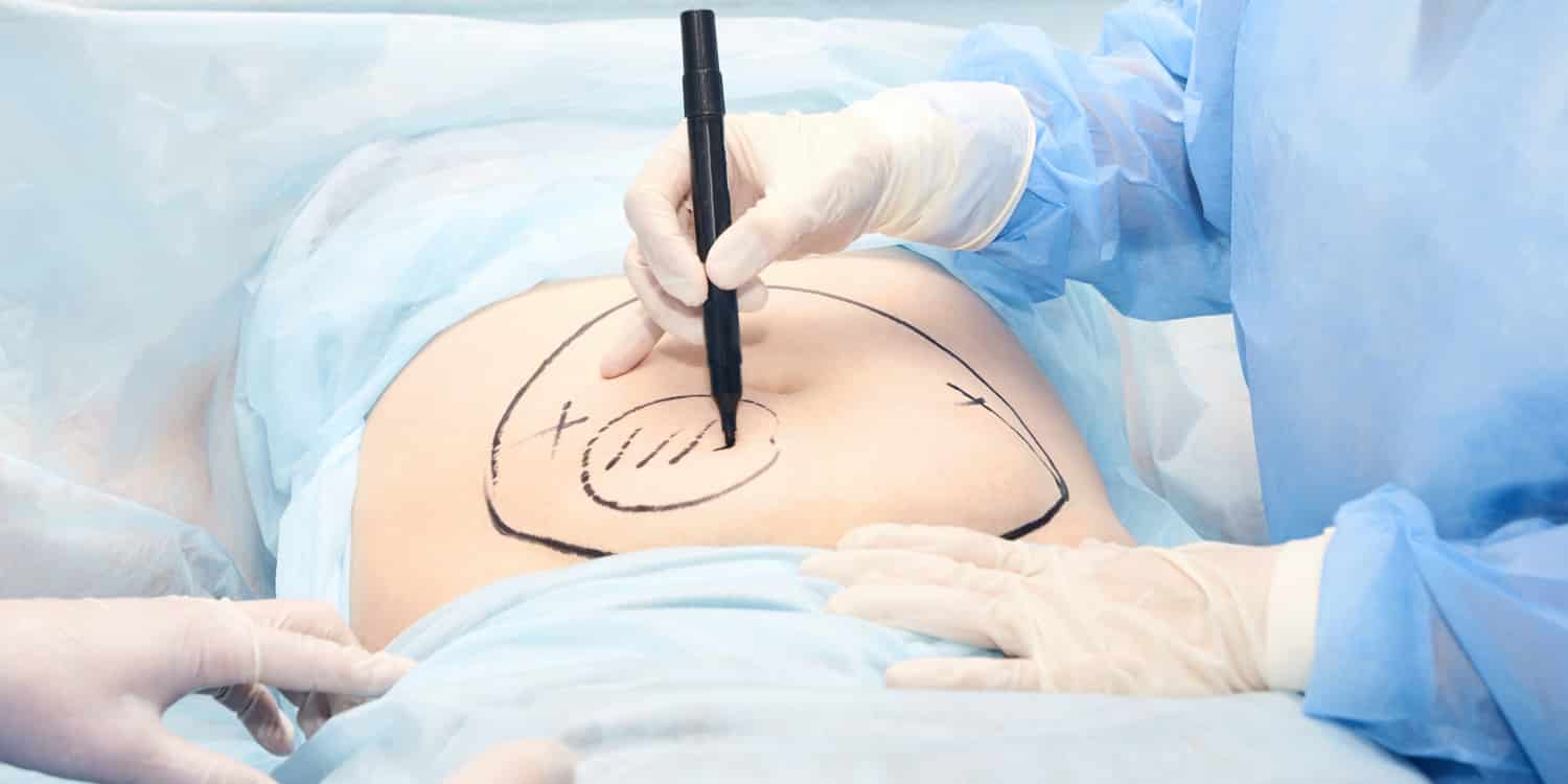 A surgeon preparing for a procedure that may leave tummy tuck scarring
