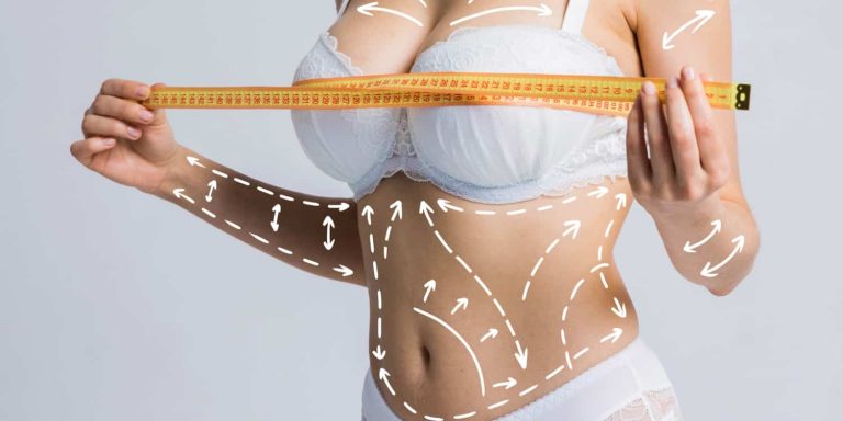 A woman in a white bra with white lines marking plastic surgery combinations