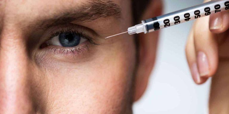 An example of botulinum toxin injections for men