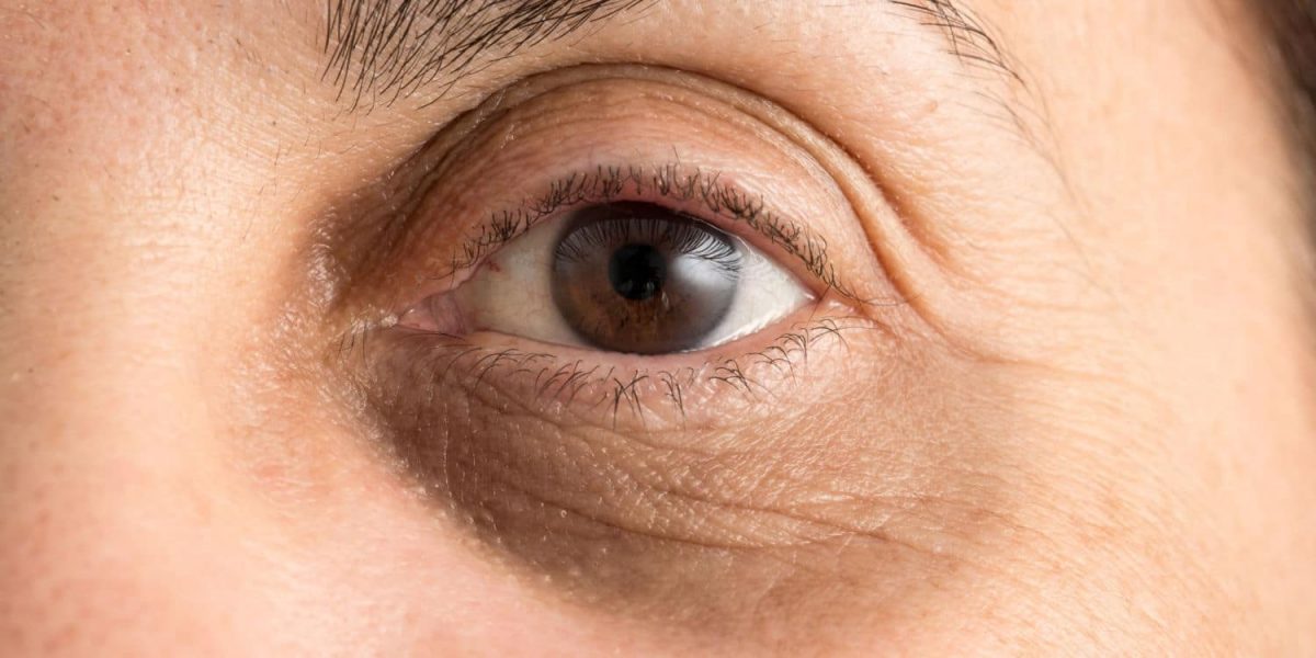 Can You Remove Under-Eye Circles?