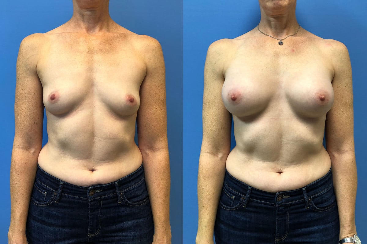 Hess-Sandeen-Breast-Augmentation-Tucson-before-after-new-1