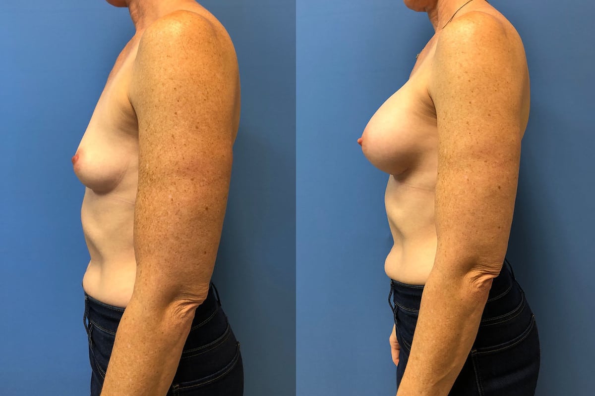 Hess-Sandeen-Breast-Augmentation-Tucson-before-after-new-2