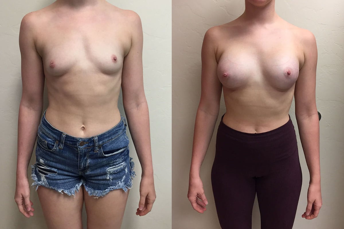 Hess-Sandeen-Breast-Augmentation-Tucson-before-after-new-4