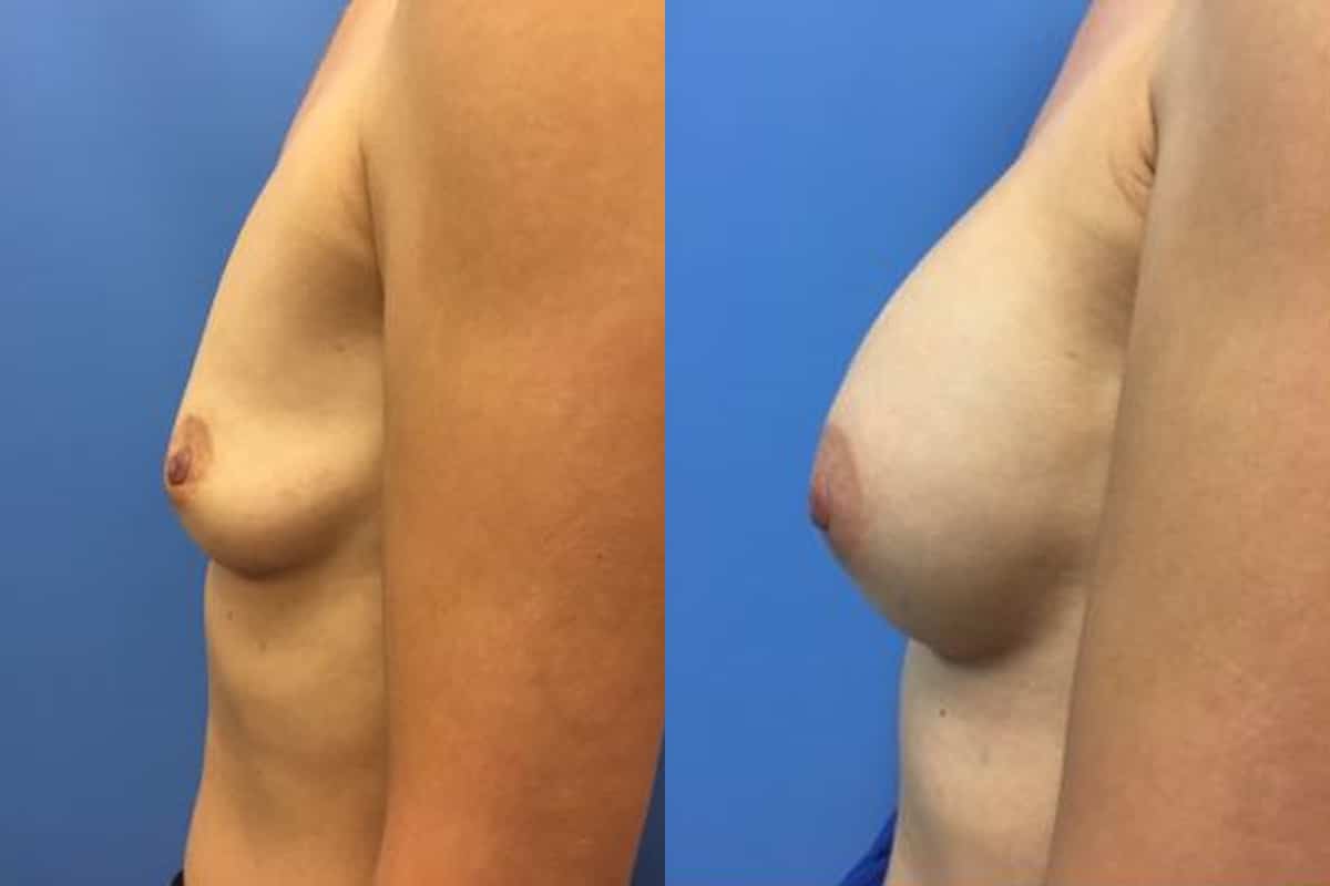 Hess-Sandeen-Breast-Augmentation-Tucson-before-after16