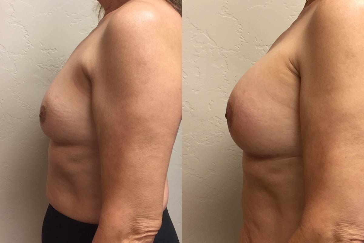 Hess-Sandeen-Breast-Augmentation-Tucson-before-after2