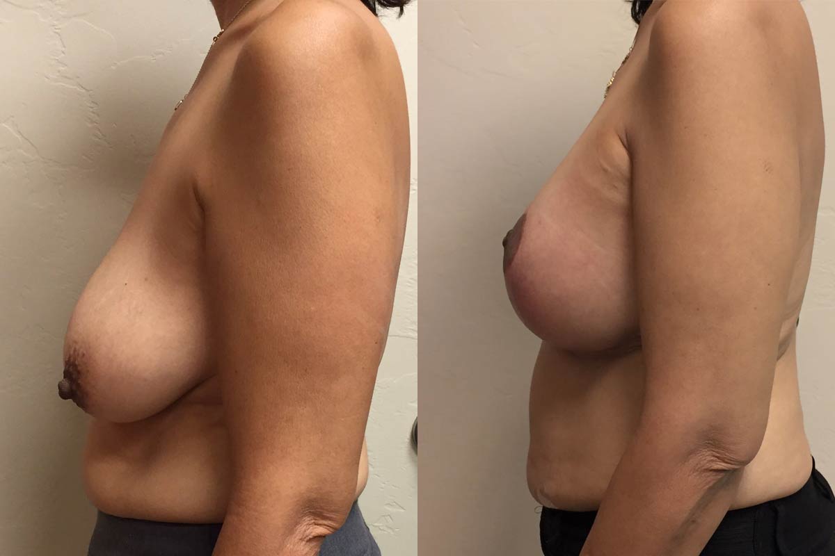 Hess-Sandeen-Breast-Augmentation-Tucson-before-after5