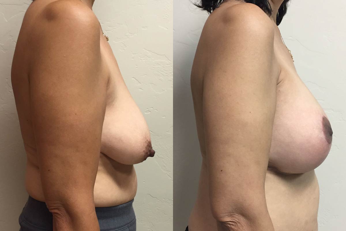 Hess-Sandeen-Breast-Augmentation-Tucson-before-after6