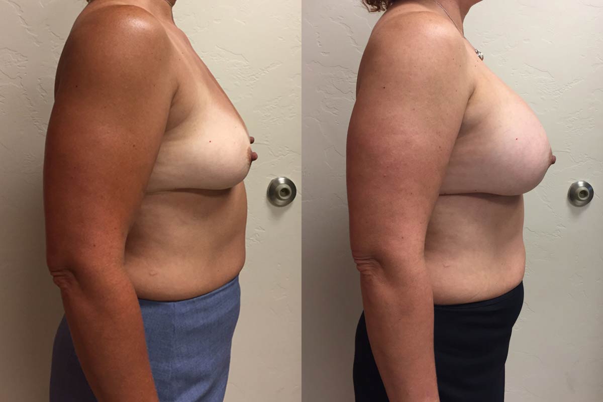 Hess-Sandeen-Breast-Augmentation-Tucson-before-after7