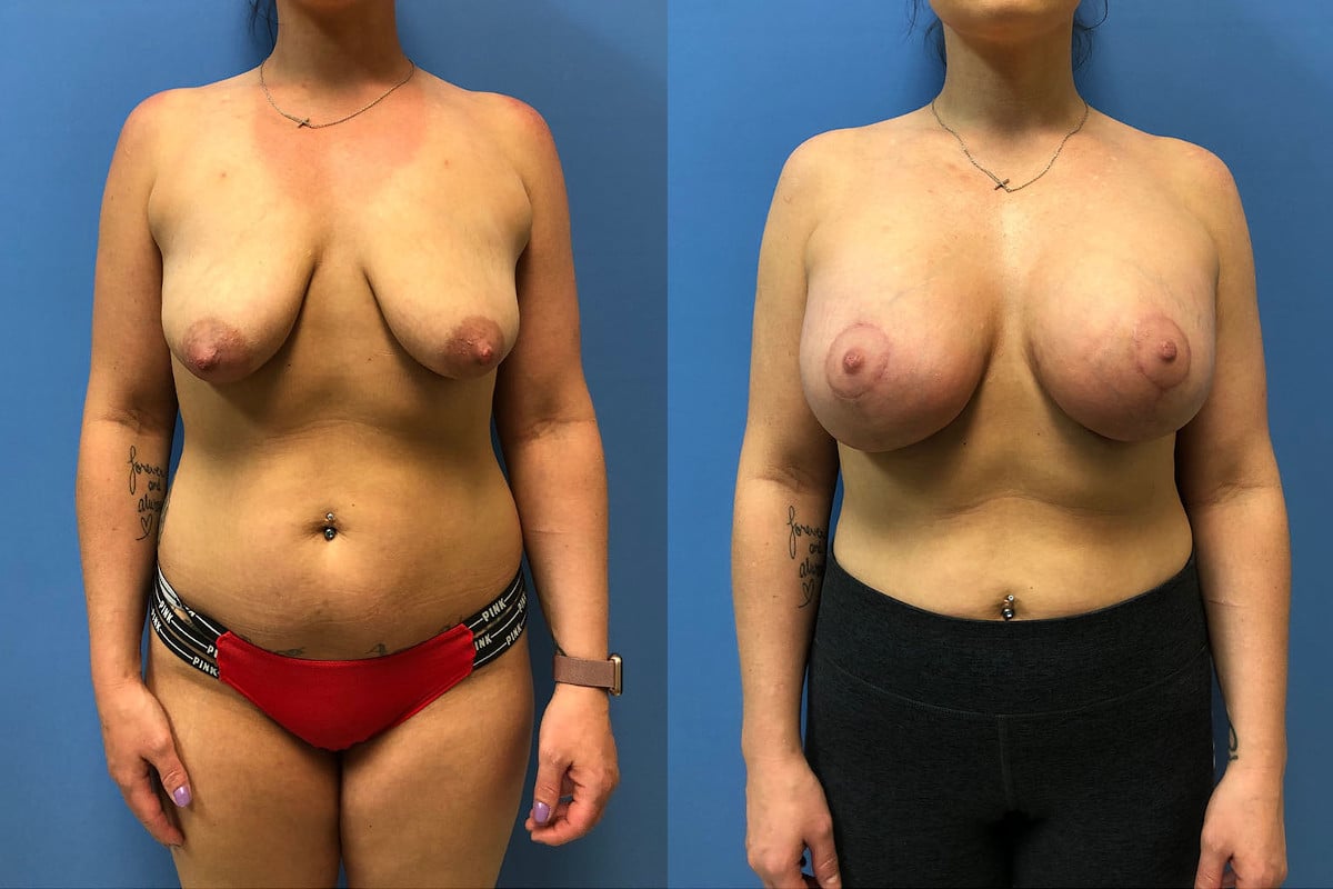 Hess-Sandeen-Breast-Augmentation-Tucson-pexy-before-after-new-1