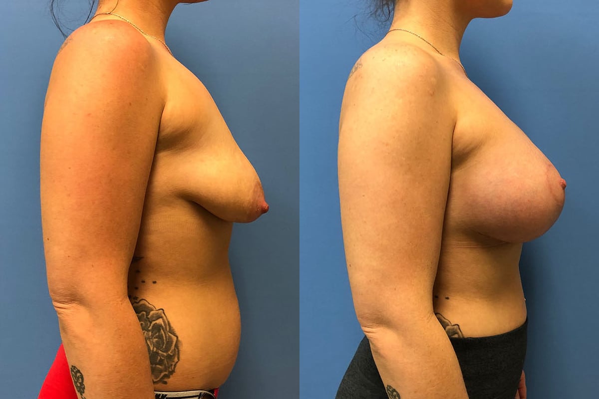 Hess-Sandeen-Breast-Augmentation-Tucson-pexy-before-after-new-2