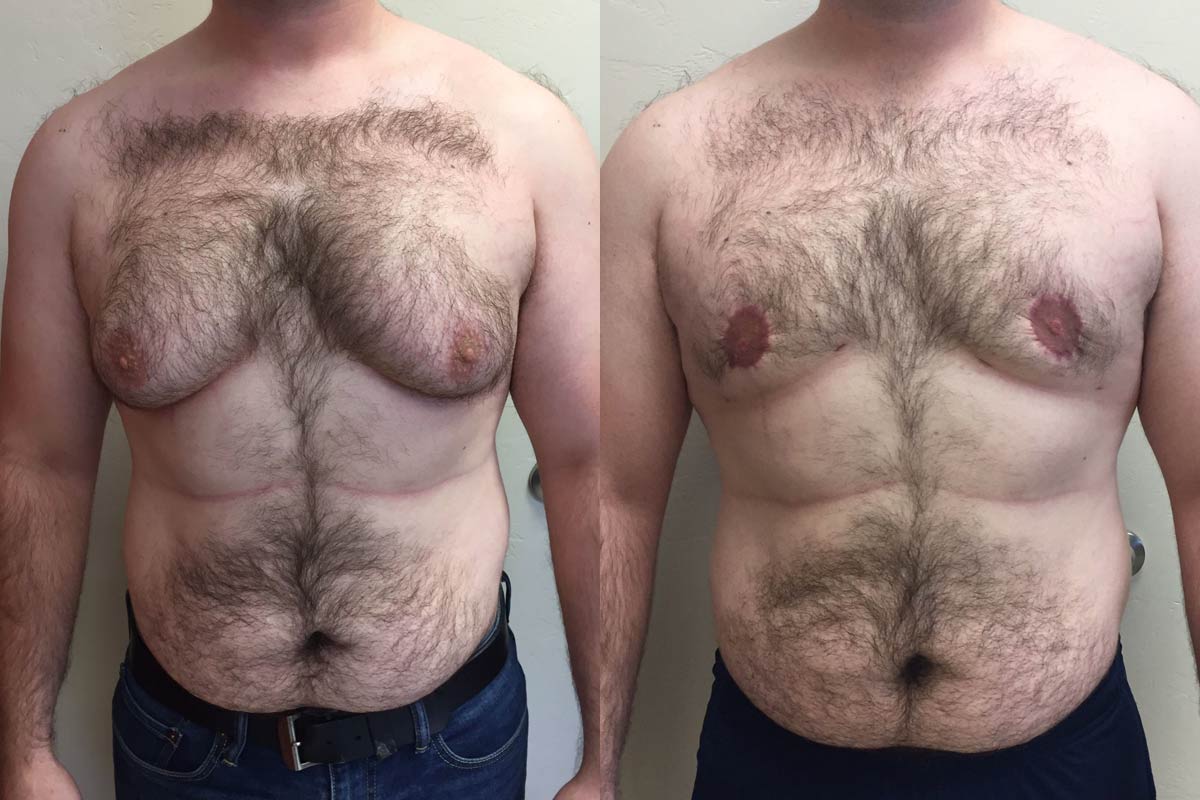 Hess-Sandeen-Gynecomastia-surgery-tucson-before-after