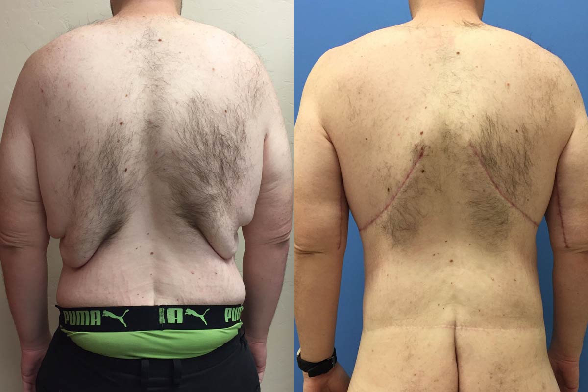 Hess-Sandeen-Gynecomastia-surgery-tucson-before-after4