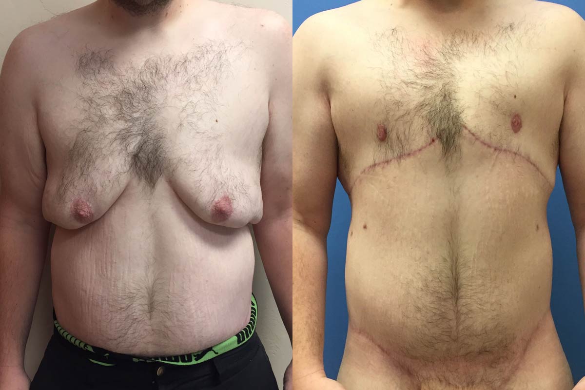 Hess-Sandeen-Gynecomastia-surgery-tucson-before-after6