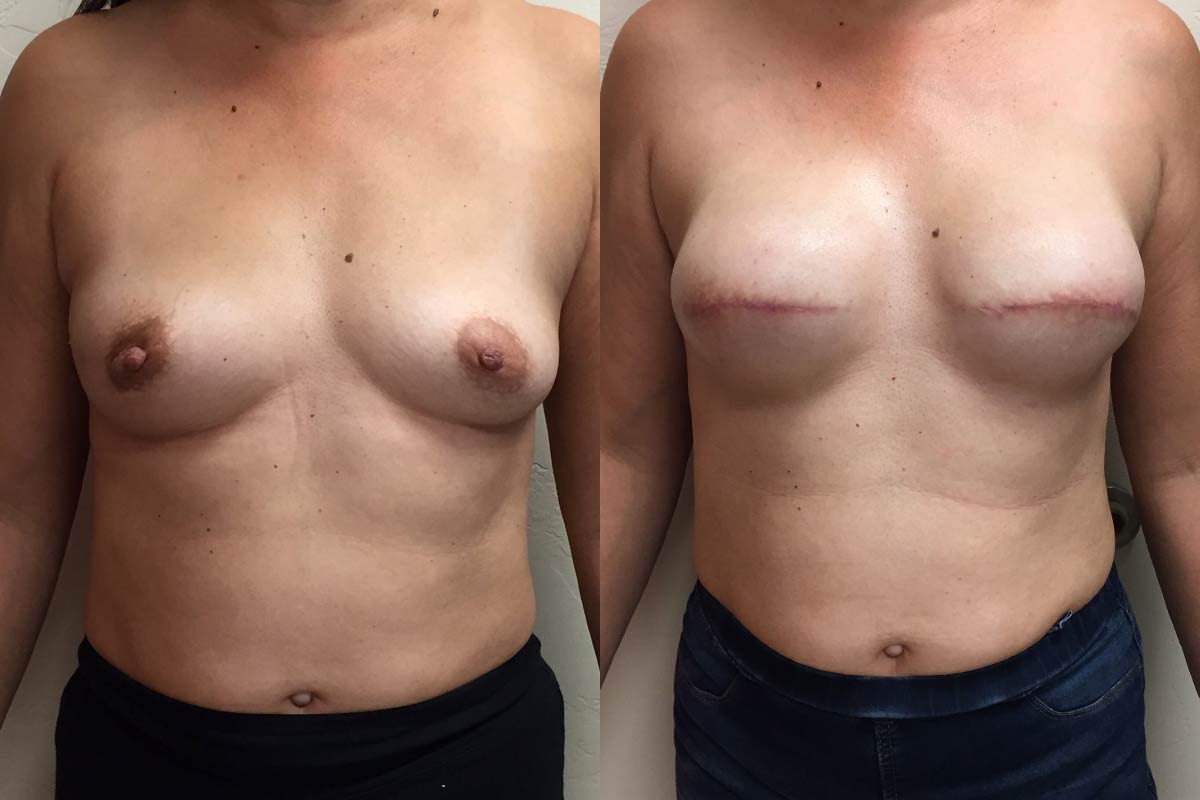 Hess-Sandeen-breast-reconstruction-tucson-before-after5