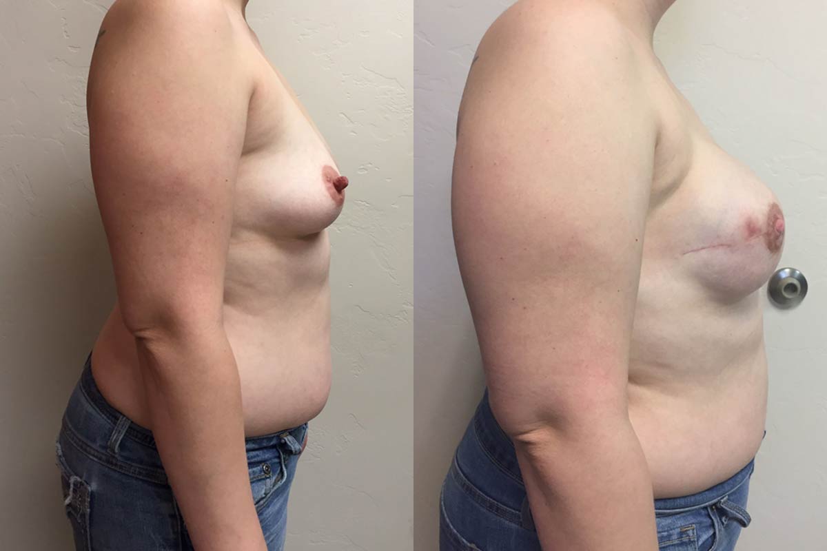 Hess-Sandeen-breast-reconstruction-tucson-before-after7