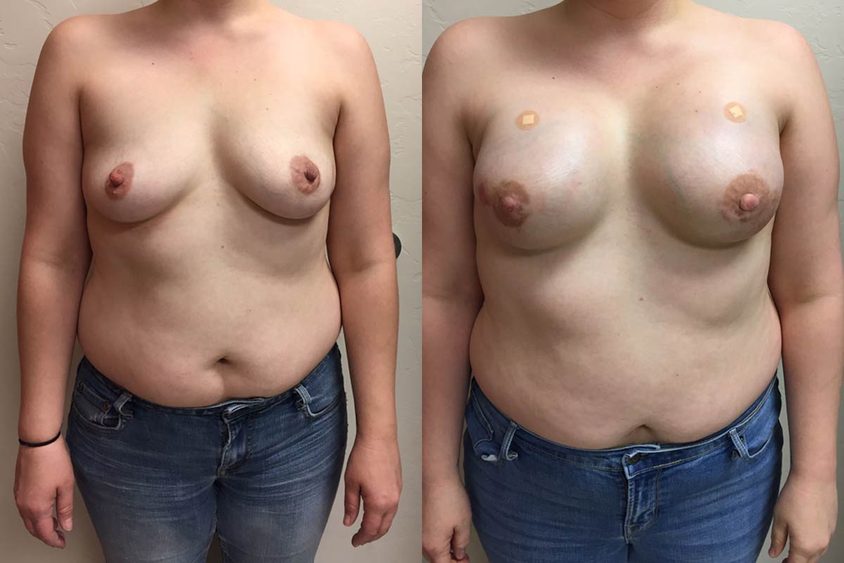 Hess-Sandeen-breast-reconstruction-tucson-before-after8