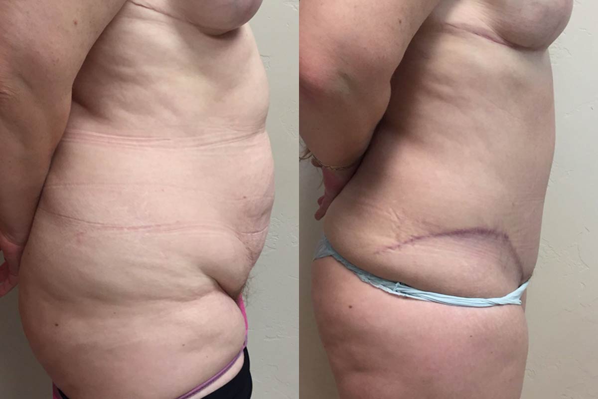 Hess-Sandeen-tummy-tuck-surgery-tucson-before-after