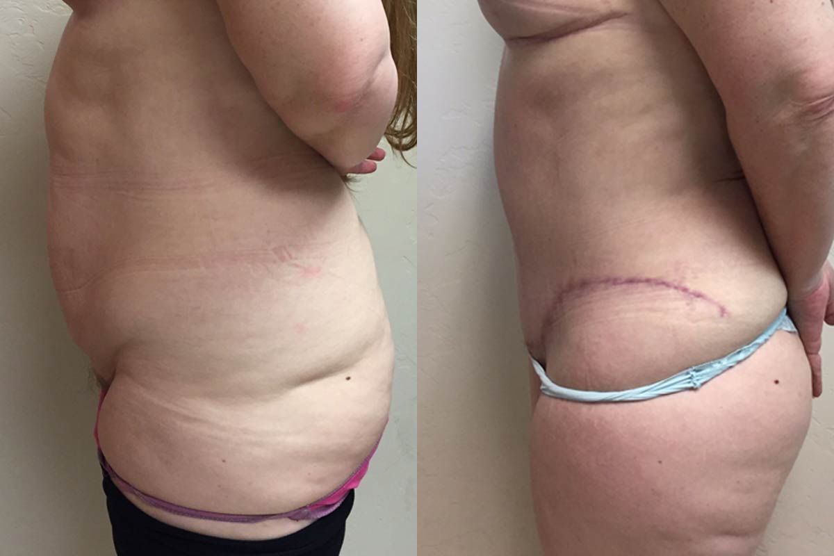 Hess-Sandeen-tummy-tuck-surgery-tucson-before-after2