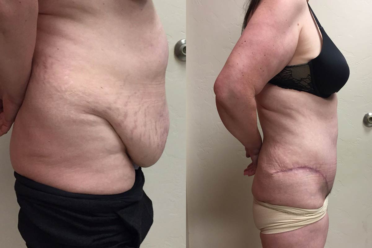 Hess-Sandeen-tummy-tuck-surgery-tucson-before-after5