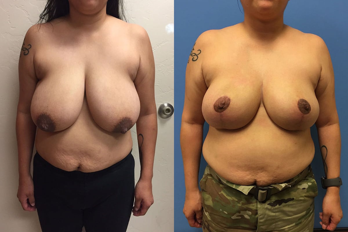 new-breast-reduction-1-1