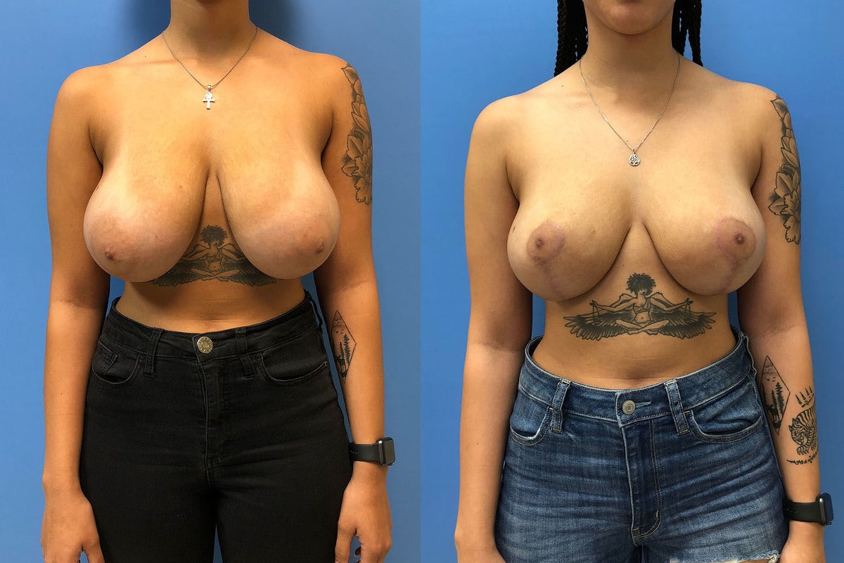 new-breast-reduction-4-1