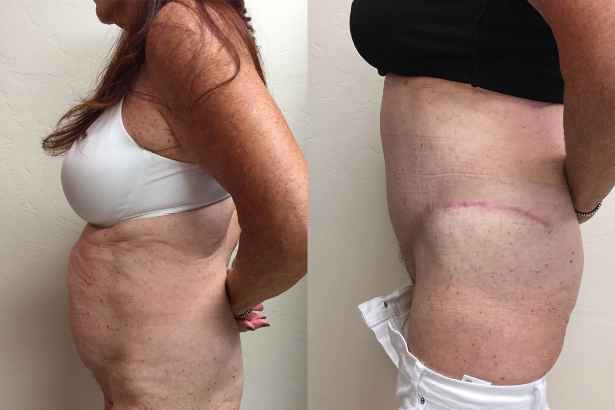 Hess-Sandeen-tummy-tuck-surgery-tucson-before-after10