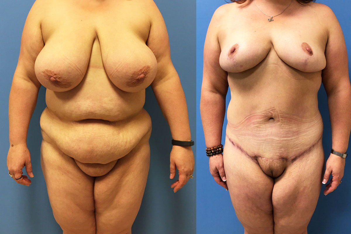 Hess-Sandeen-tummy-tuck-surgery-tucson-before-after15