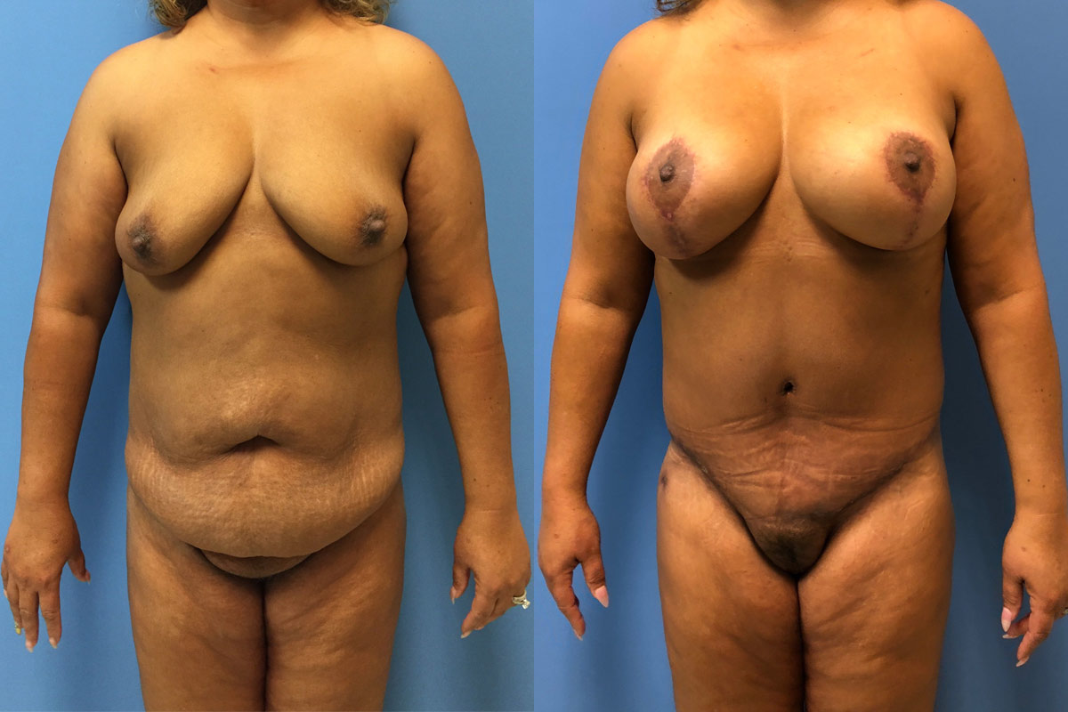 Hess-Sandeen-tummy-tuck-surgery-tucson-before-after17