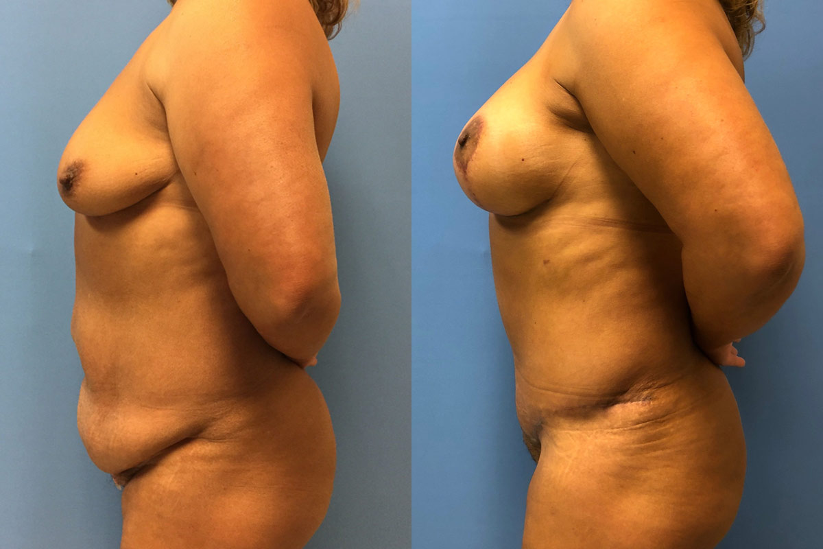 Hess-Sandeen-tummy-tuck-surgery-tucson-before-after18