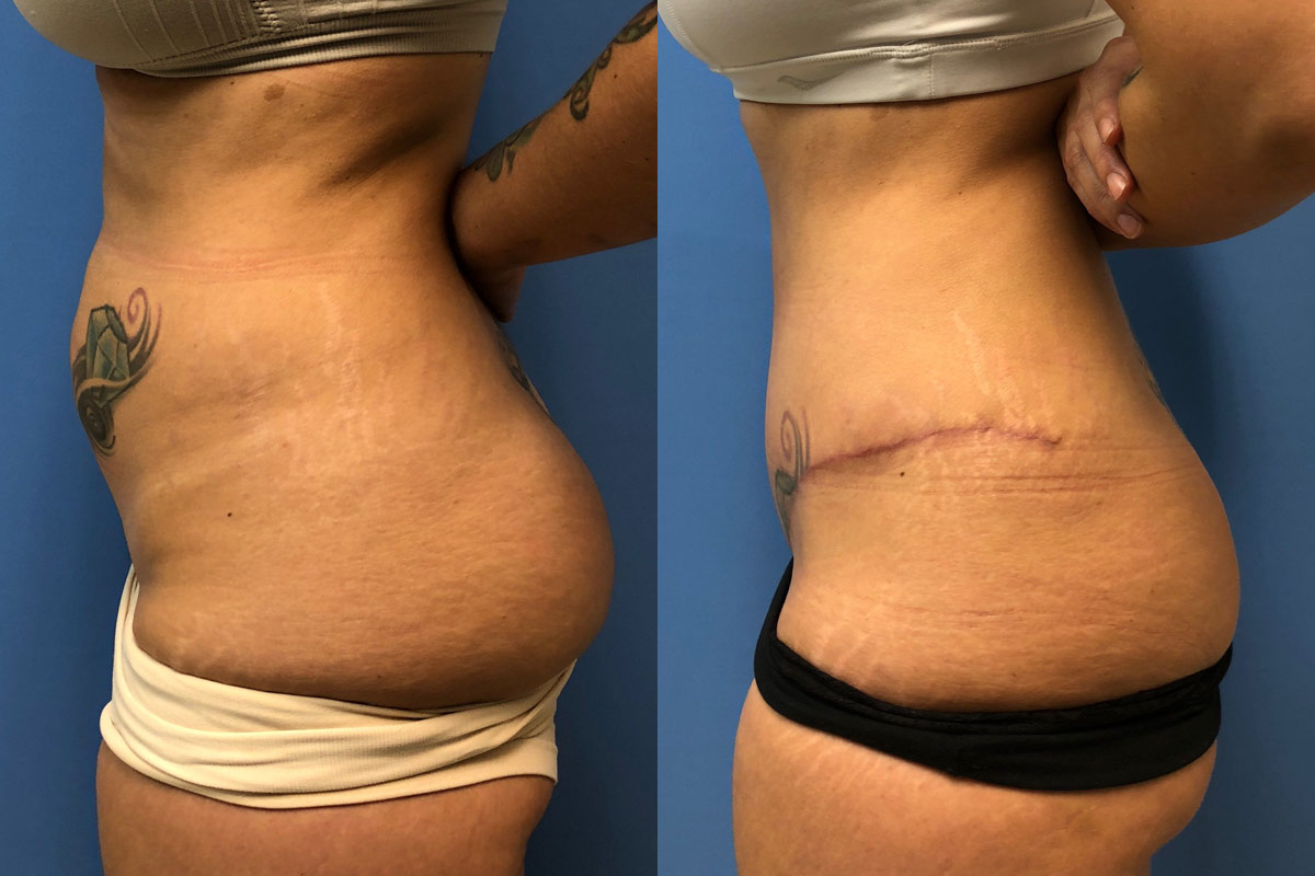 Hess-Sandeen-tummy-tuck-surgery-tucson-before-after19