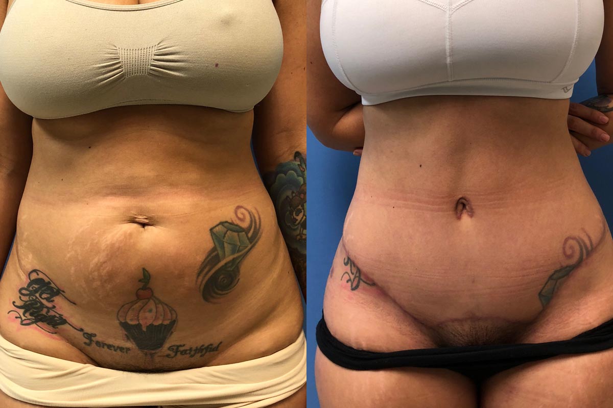 Hess-Sandeen-tummy-tuck-surgery-tucson-before-after20