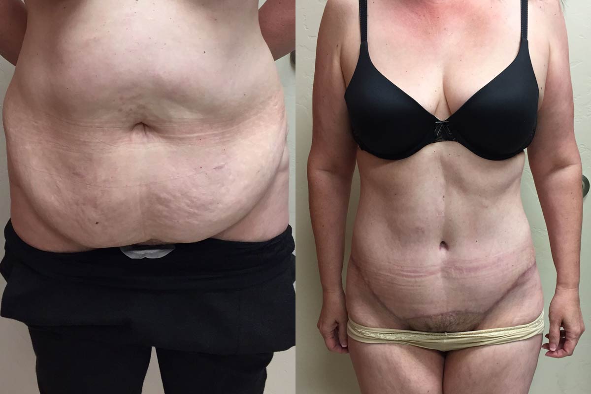 Hess-Sandeen-tummy-tuck-surgery-tucson-before-after3