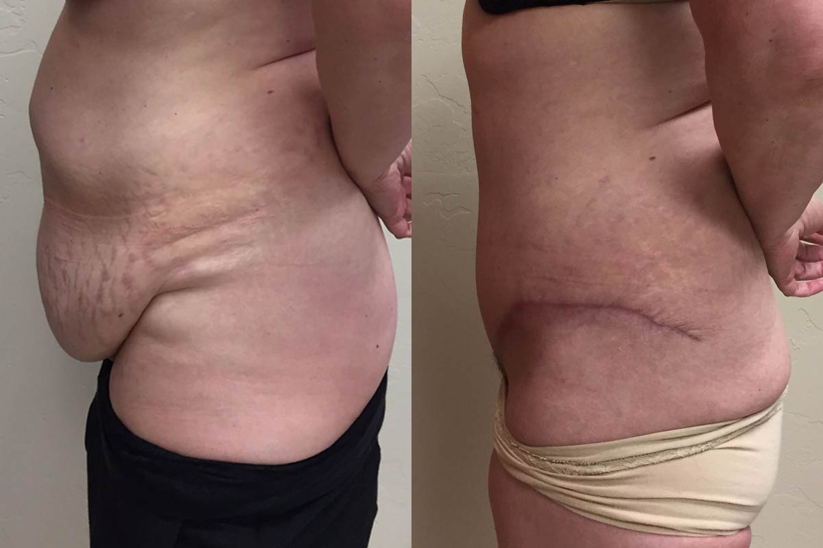 Hess-Sandeen-tummy-tuck-surgery-tucson-before-after4