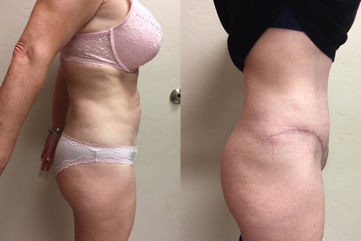 Hess-Sandeen-tummy-tuck-surgery-tucson-before-after8