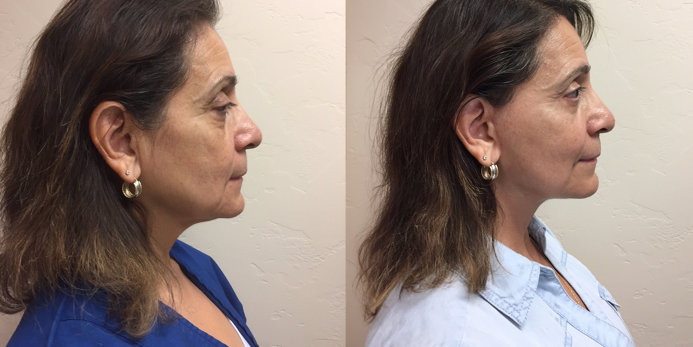 Hess-Sandeen-Facelift-Tucson-before-after6-1024x683