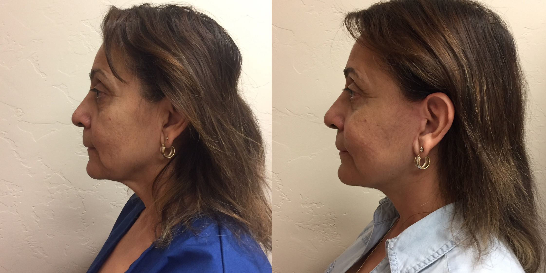 Hess-Sandeen-Facelift-Tucson-before-after7-1024x683