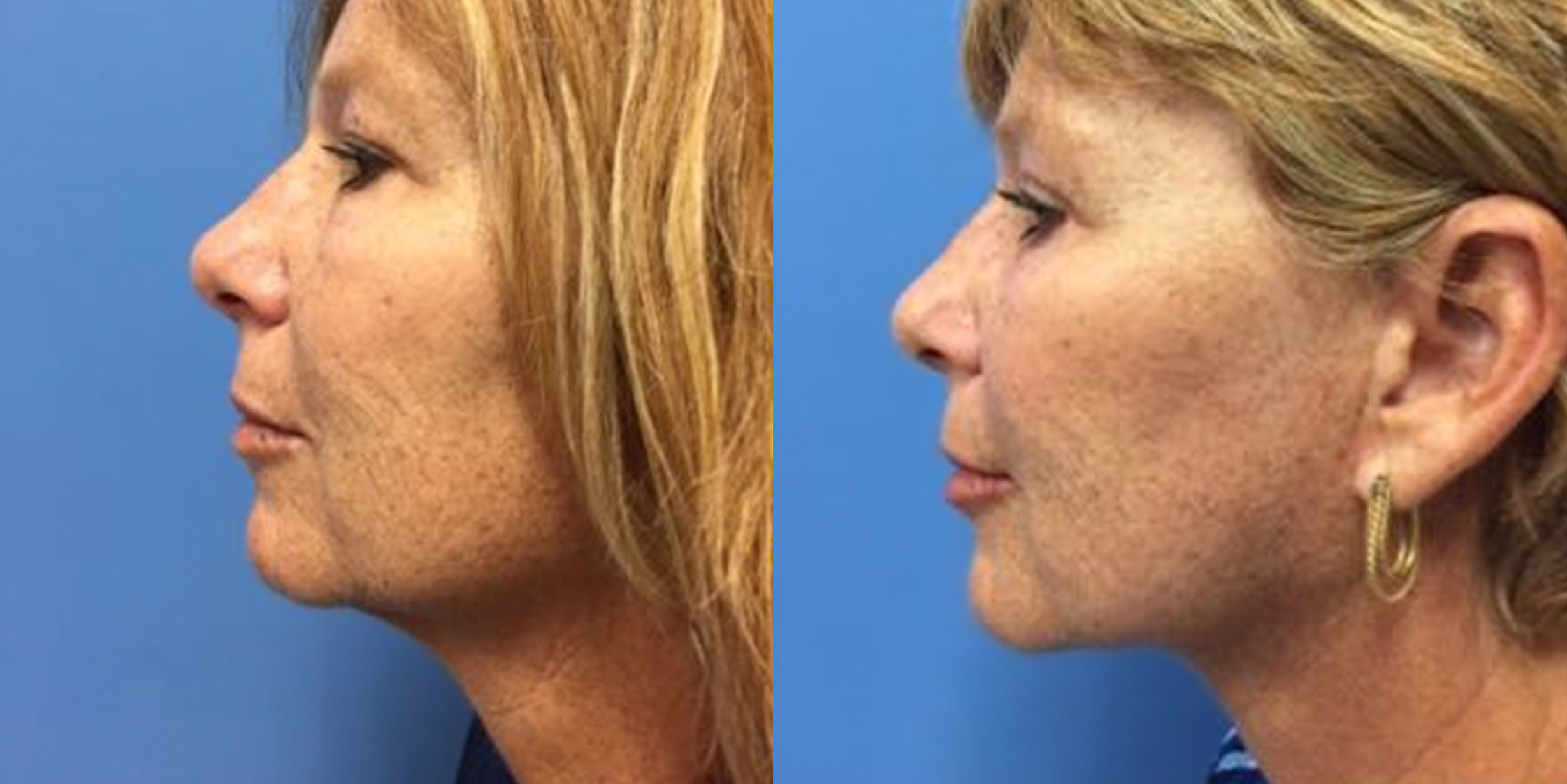 Hess-Sandeen-Facelift-Tucson-before-after17-1024x683