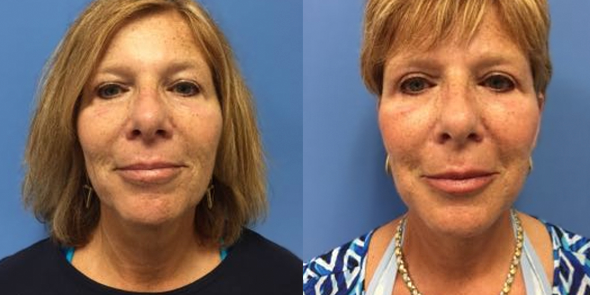 Hess-Sandeen-Facelift-Tucson-before-after18-1024x683