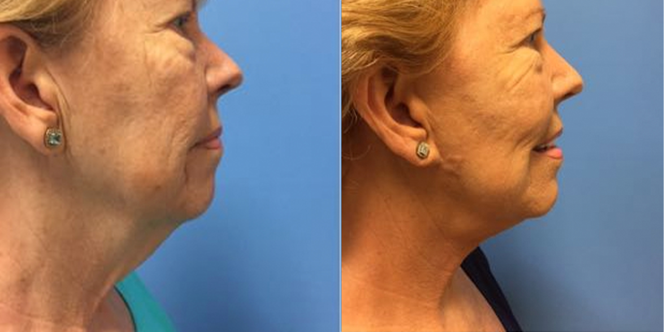 Hess-Sandeen-Facelift-Tucson-before-after10-1024x683