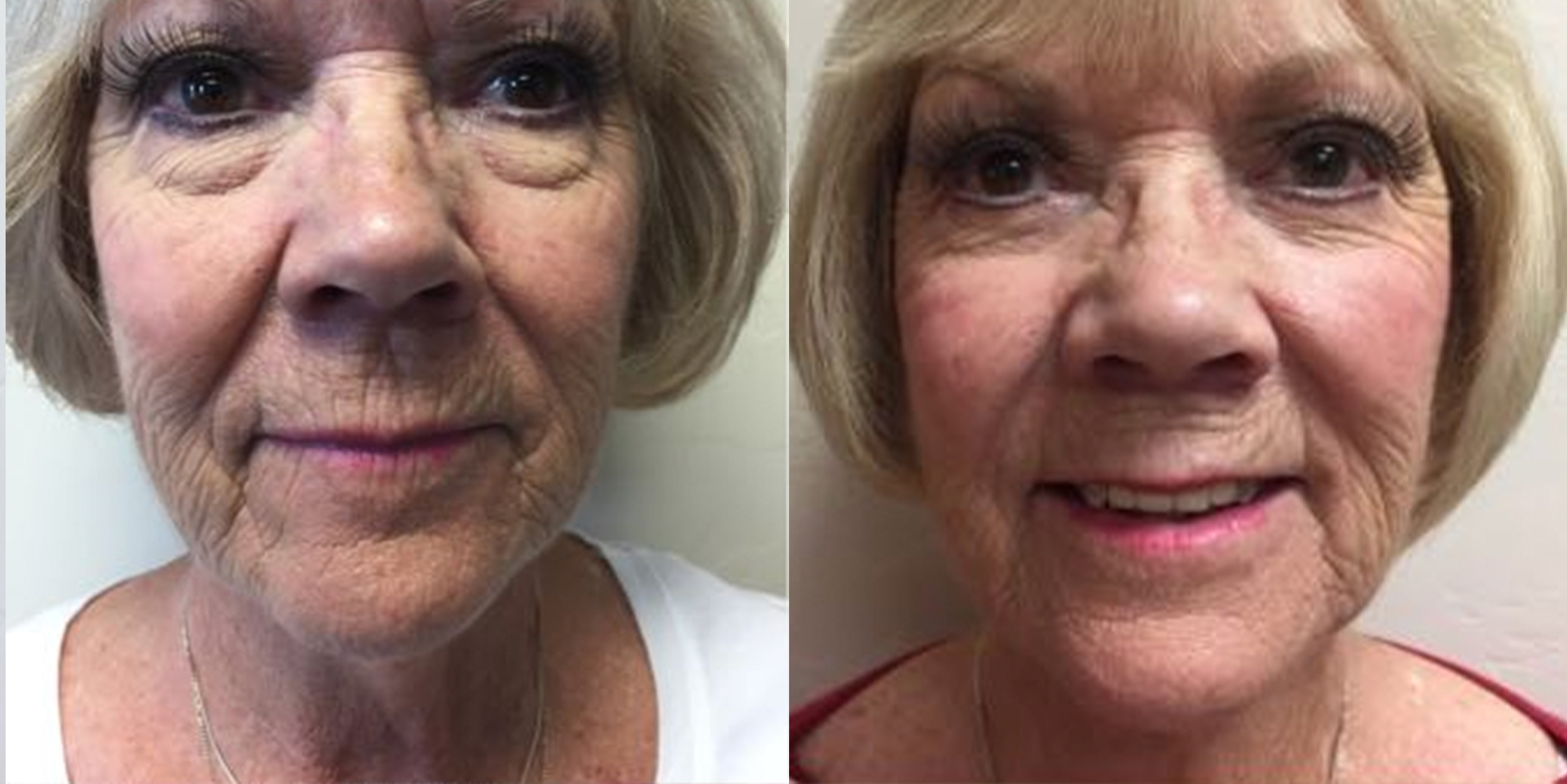Hess-Sandeen-Facelift-Tucson-before-after15-1024x683