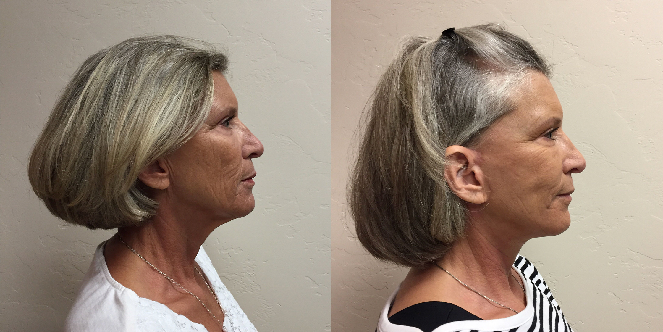 Hess-Sandeen-Facelift-Tucson-before-after-1024x683