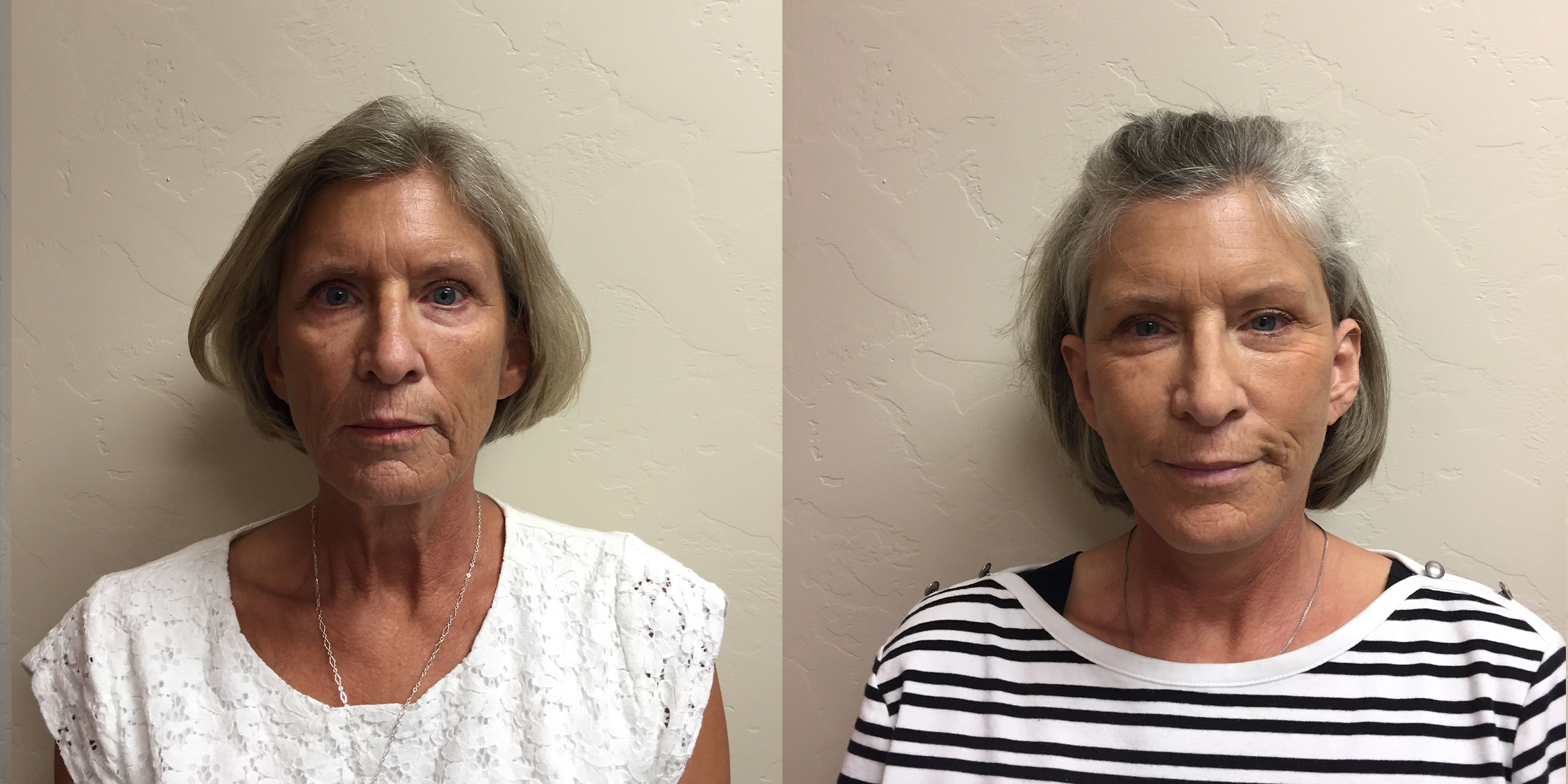 Hess-Sandeen-Facelift-Tucson-before-after-1024x683