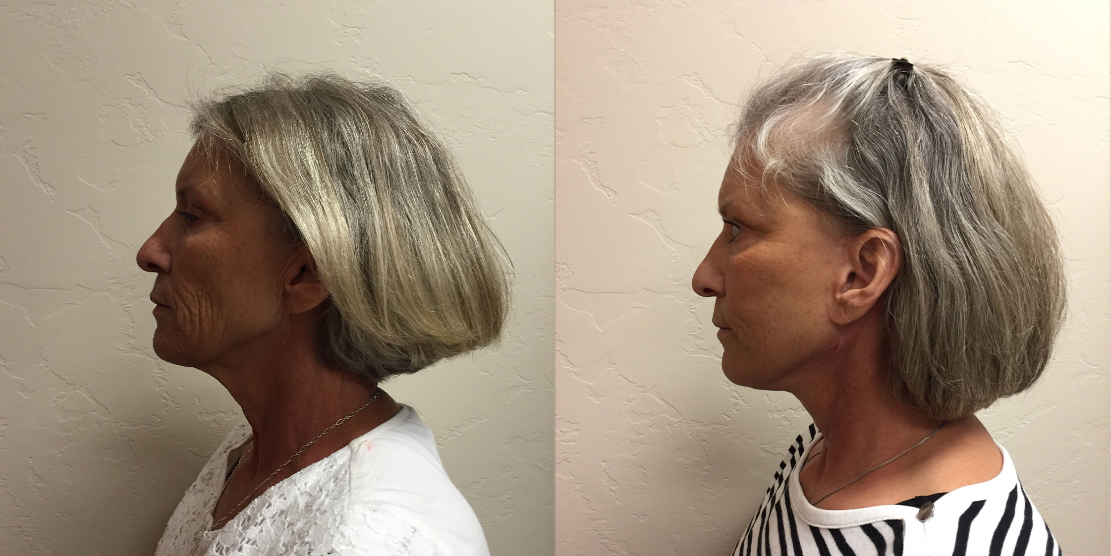 Hess-Sandeen-Facelift-Tucson-before-after2-1024x683
