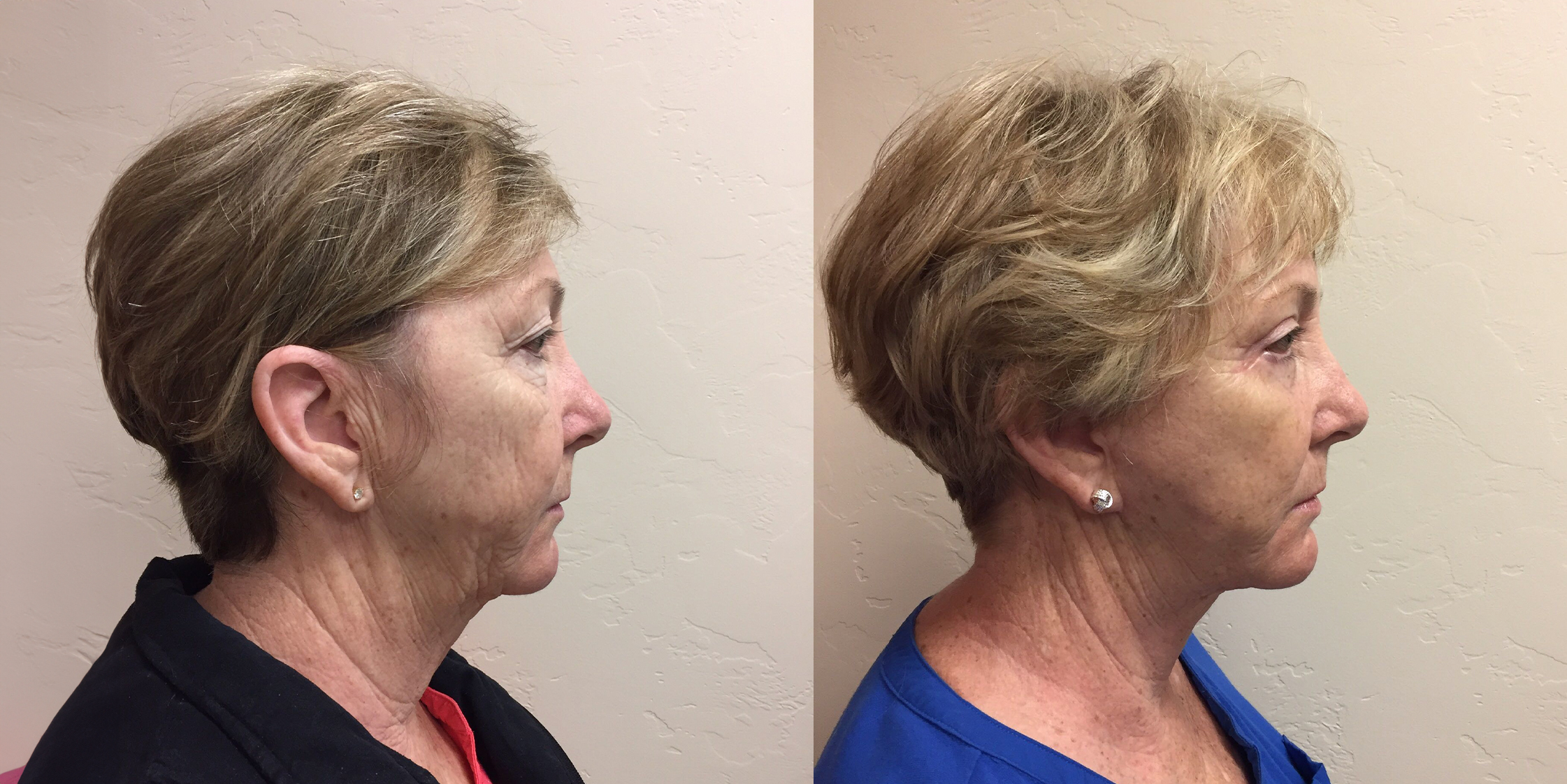 Hess-Sandeen-Facelift-Tucson-before-after5-1024x683