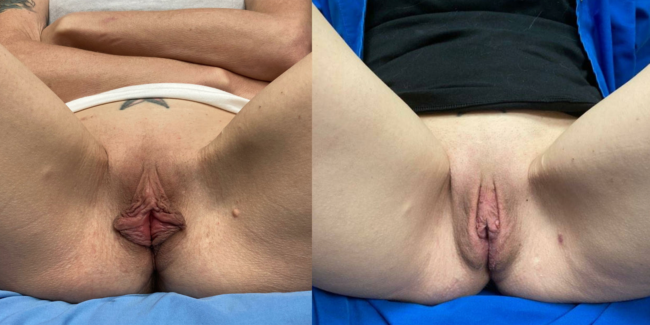 Hess-Sandeen-Breast-Augmentation-Tucson-before-after-new-1